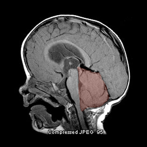 enlarged cerebellum and cerebellar tonsillar herniation at six months